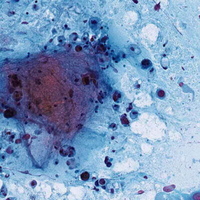 Cytology Slide Sample: Abnormal Mass of Cells