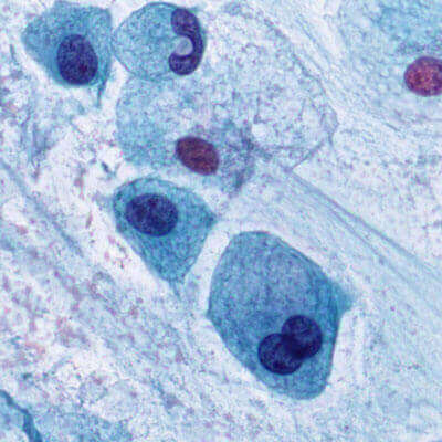 Cytology Slide Sample: Lung Cells