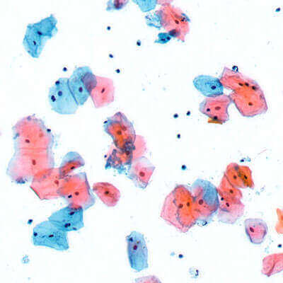 Cytology Slide Sample: Sputum Smear