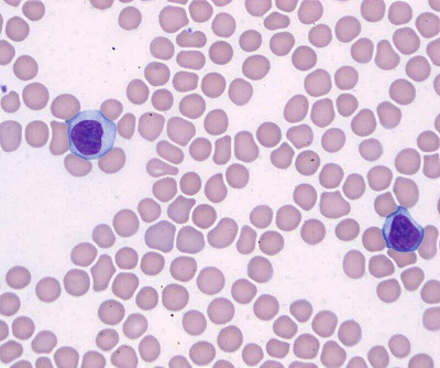 Hematology Pro Blood Smear Slide Sample: Rapid Wright Giemsa - 3