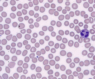 Hematology Pro Blood Smear Slide Sample: Rapid Wright Giemsa - 5