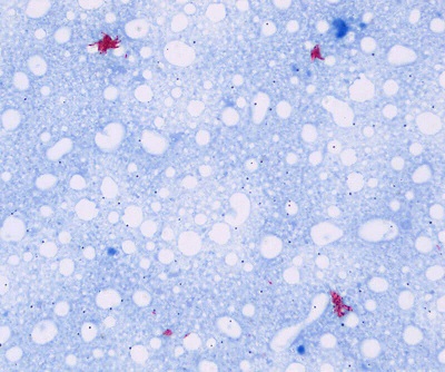 TB Slide Sample: Carbol Fuchsin